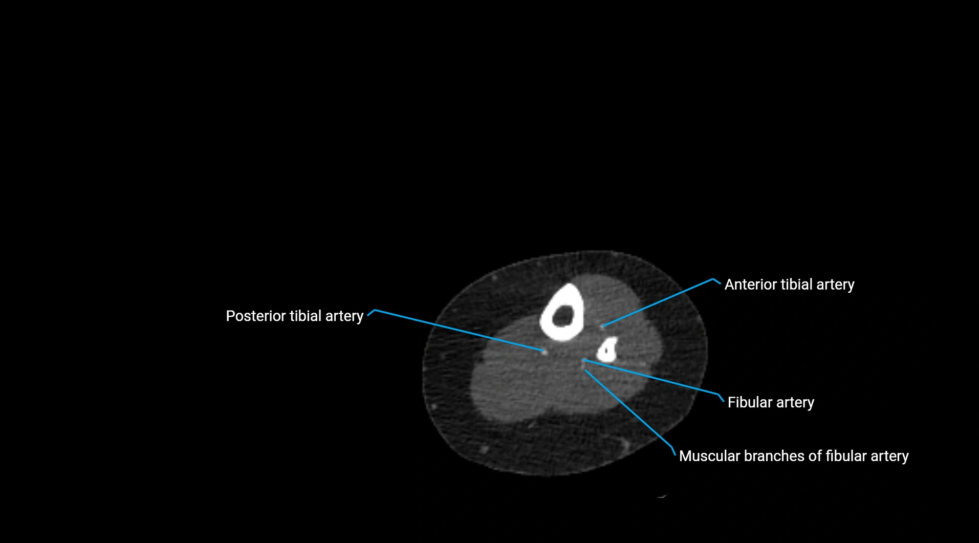 CTA lower limb cross sectional anatomy labelled image _219.webp